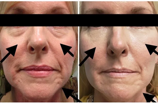 Cheeks and nasolabial folds before and after dermal filler, shown side by side