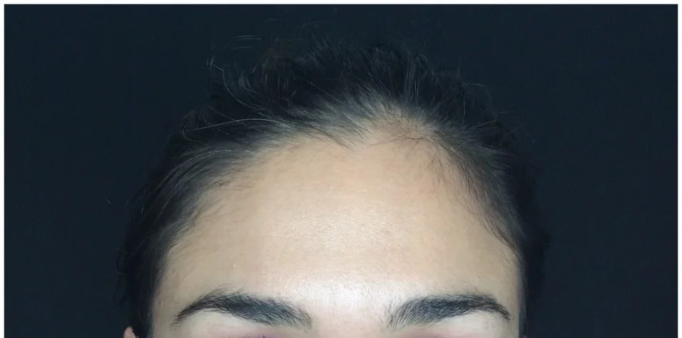 Forehead lines after Botox treatment