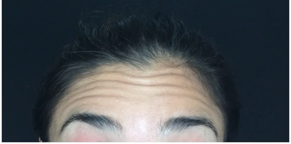 Forehead lines before Botox treatment
