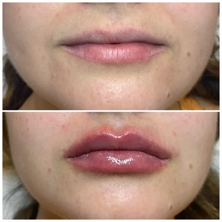 Lips before and after dermal filler, shown above and below