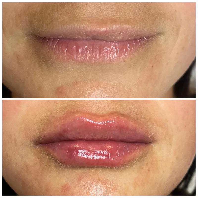 Lips before and after dermal filler, shown above and below