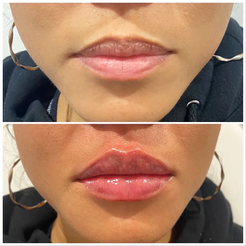 Lips before and after dermal filler, shown above and below