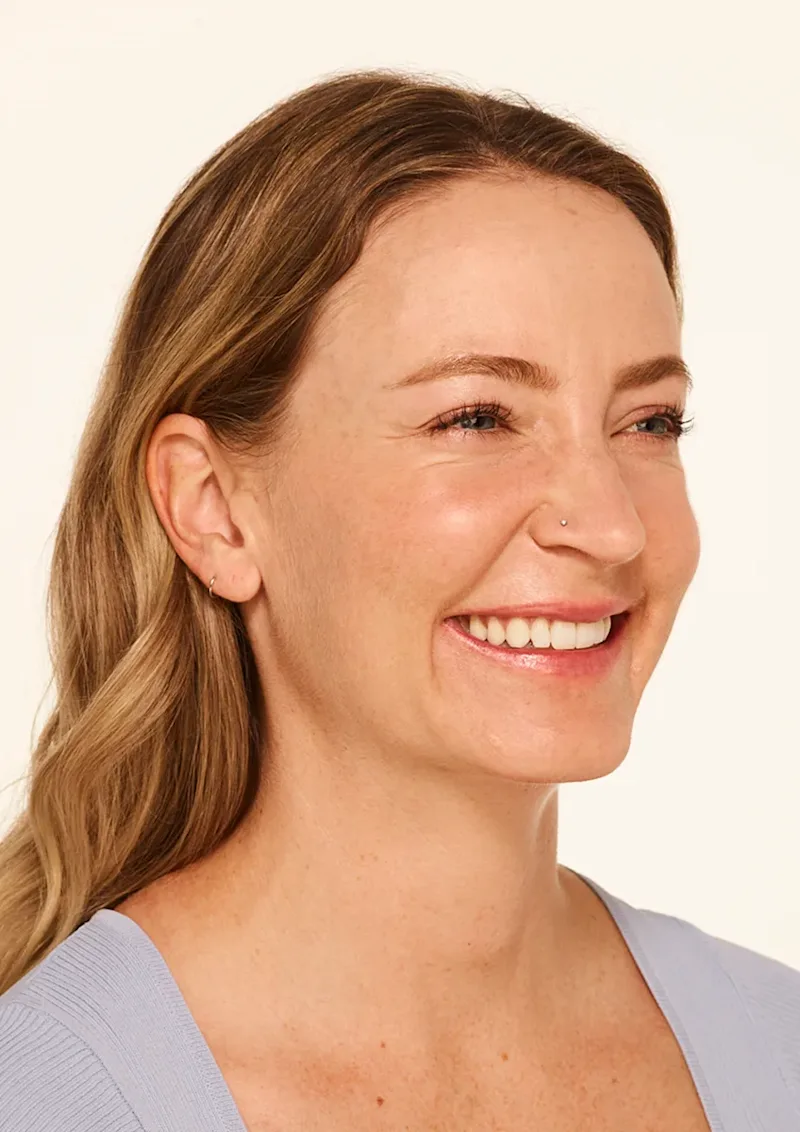 Mandy before Botox treatment