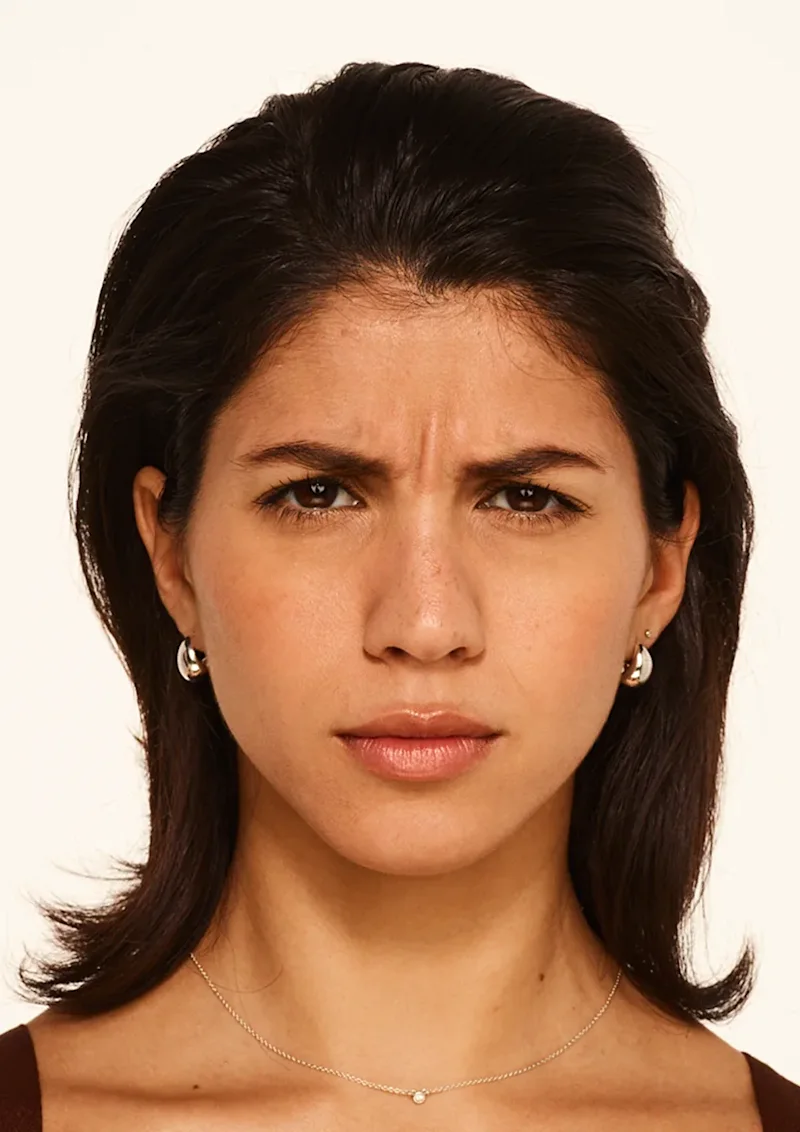 Nicole before Botox treatment